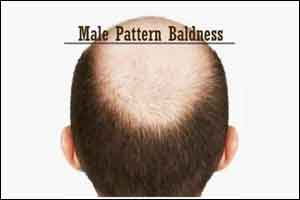 Adding Finasteride to topical Minoxidil improves outcomes in baldness