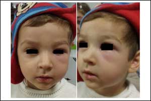 Recurrent hemifacial oedema