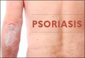 Alternative medicine therapies found  effective in Psoriasis : JAMA