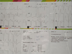 Silent Myocardial Infarction During Hypoglycemic Coma