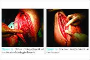 Rare Case of Upper Arm Compartment Syndrome Following Biceps Tendon Rupture