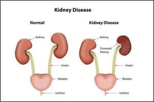 Saline hydration alone  minimizes contrast-induced nephropathy after angiography