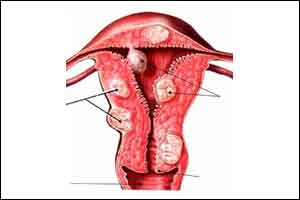 How to manage anticoagulant associated Heavy Menstrual Bleeding