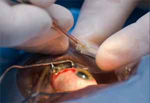 Combined Cataract Surgery Ups Postop Endophthalmitis Risk