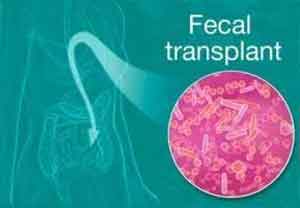 Now Fecal transplant by oral capsule  to prevent Clostridium difficile infection