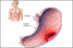 How Helicobacter pylori causes gastric cancer