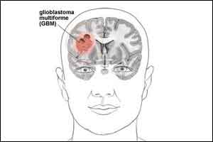 Onalespib could be an effective treatment for glioblastoma