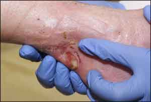 More effective treatment of diabetic wounds in sight