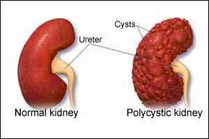 Tolvaptan slows kidney function decline in  Polycystic kidney disease