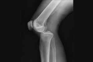 MRI inferior to arthroscopy for diagnosing chondral defects of the knee