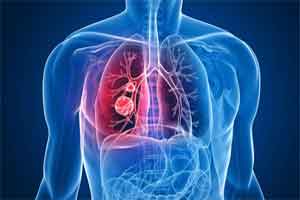 FDA approves imfinzi (durvalumab) for unresectable stage III non-small cell lung cancer