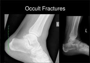 Sonographic Diagnosis of occult fractures