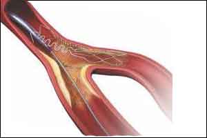 Bare-metal stent better then drug preventing stent in elder more than 75 years