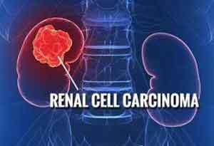 FDA  approves  Sunitinib malate for reduction of  risk of kidney cancer after nepherectomy