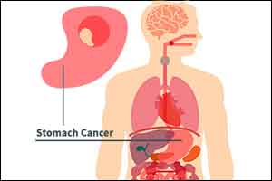 Periodontal disease linked to precancerous lesions of stomach cancer