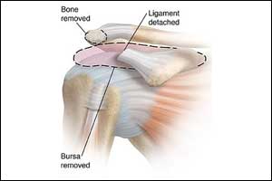 Arthroscopy not found beneficial in subacromial shoulder pain