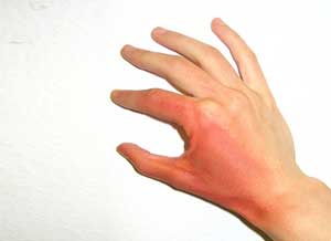 Concomitant use of Topical Pain Relievers and a Heat Source may cause burns