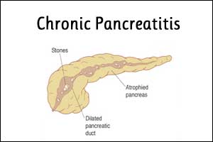 Chronic Pancreatitis Imaging Clinical Practice Guidelines