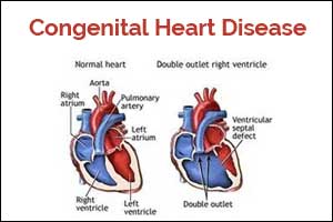 AHA Clinical Practice Guidelines for adults with Congenital Heart Disease