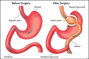 DSS & Diabetes UK  Guidelines  for Metabolic surgery in treatment of Type 2 diabetes