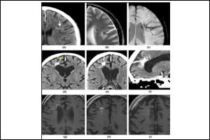 Some Neuroanatomical Variants usually misinterpreted radiologically