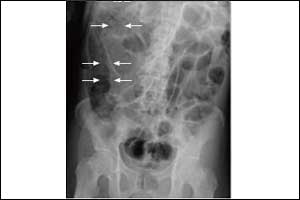 A case of Pneumatosis Cystoides Intestinalis