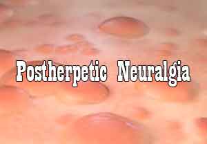 Botox effective for pain relief in Post Herpetic Neuralgia