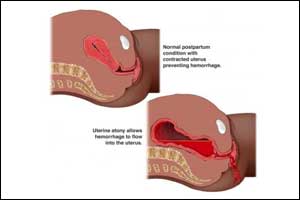 Uterine balloon tamponade highly effective in preventing maternal death from PPH