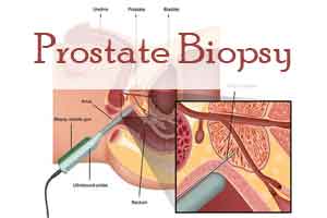 New Prostate Biopsy Procedure for better detection of cancerous prostate cells