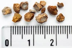 Tamsulosin Improves passage of Large distal Ureteric Stones