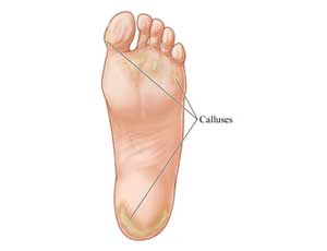 Sonographic evaluation of callus