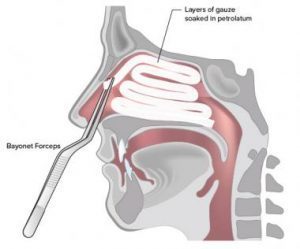 A case of ‘brain stem Anaesthesia following intranasal packing with lignocaine and adrenaline