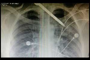 AIIMS Doctors successfully removed Ice pick lodged in mans chest