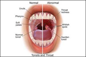 NICE sore throat guideline: antimicrobial prescribing