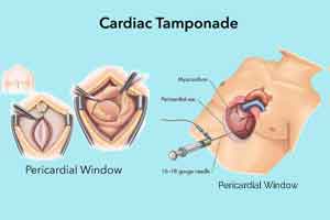 Cardiac Tamponade: Causes, Symptoms, Treatment