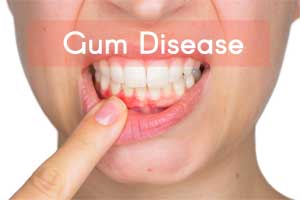 People with Gum disease at increased risk of developing RA