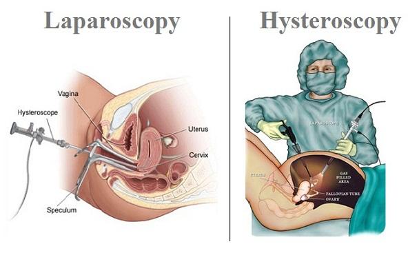 Hysteroscopic sterilization or Surgical sterilization: JAMA study