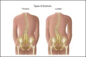 Scoliosis linked to essential mineral Manganese