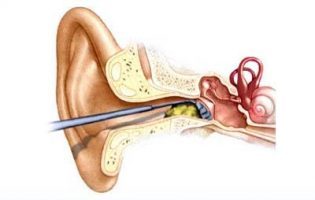 Ear infections can lead to meningitis, brain abscess and other neurological complications