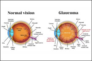 Study advances gene therapy for glaucoma