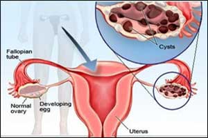 Simple Ovarian Cysts on Ultrasound Need No Further Monitoring