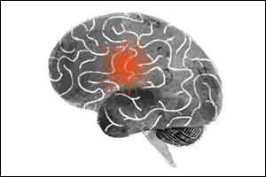 A Simple test which recognises posterior stroke