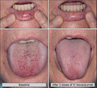 Bevacizumab controls  severe bleeding in Hereditary hemorrhagic telangiectasia