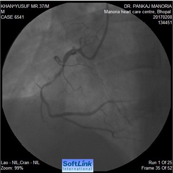 Primary Angioplasty of RC Arising From Left Sinus of Valsalva - Case by Dr Pankaj Manoria