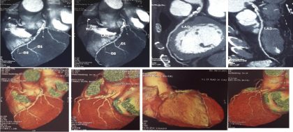 Multi Modality Approach in Managing Triple Vessel Disease-Case by Dr Sridhar Kasturi