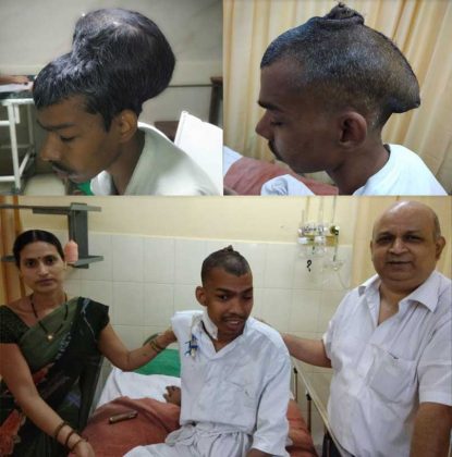 Nair Hospital Surgeons Remove World’s Largest Brain Tumour Weighing 1.8kg
