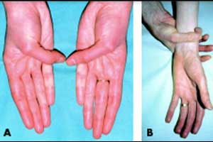 Why losartan is effective in Marfan Syndrome?