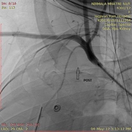 Simple balloon occlusion to seal sub artery peroration - Case by Dr MV Reddy