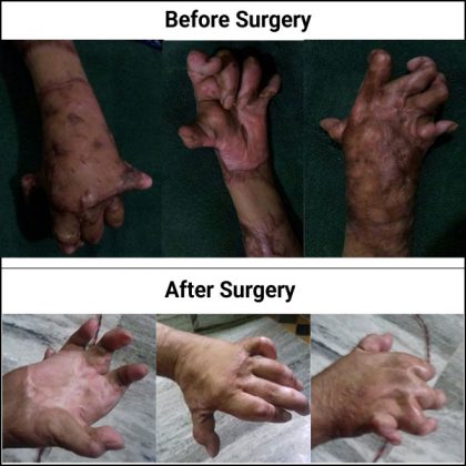 Severe Post burn deformities of yemeni citizen successfully treated at KIMS Hospital