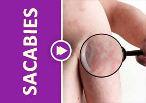 EDF Guideline on the Management of Scabies